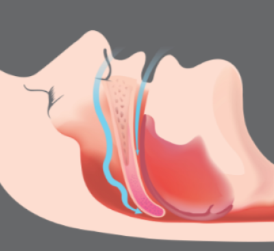 Sleep Apnea