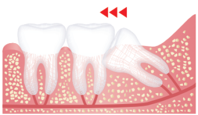 Crowding Teeth