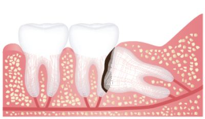 Damage to Adjacent Teeth